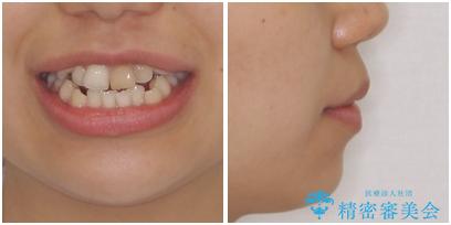 八重歯の抜歯矯正　費用を抑えた矯正装置の治療前（顔貌）