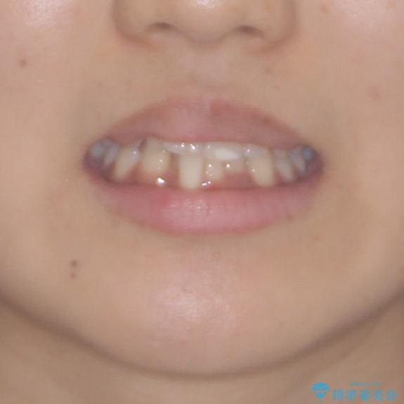 短期間での歯列矯正　ワイヤー矯正であっという間にの治療前（顔貌）