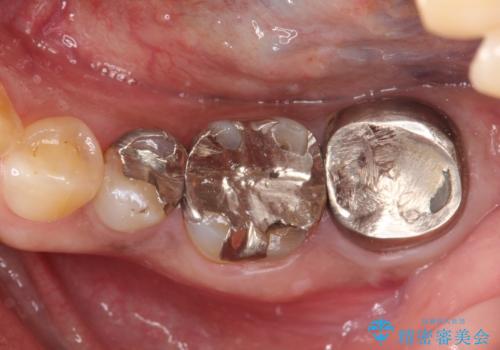 他院で治療しても治らない。奥歯の治療。の症例 治療前