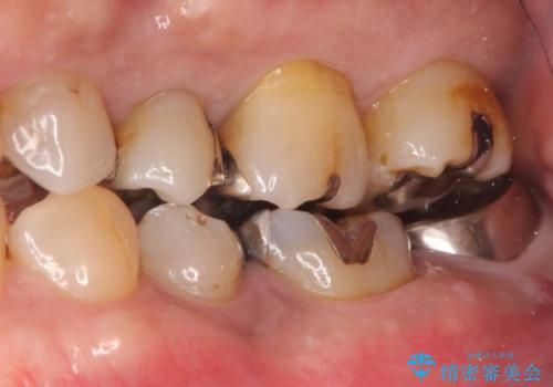 他院で治療しても治らない。奥歯の治療。の治療前
