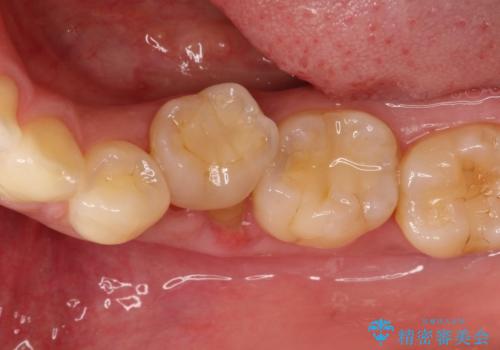 奥歯が痛い。乳歯を抜歯し、ブリッジによる咬合回復。の治療前