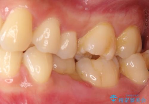 奥歯が痛い。乳歯を抜歯し、ブリッジによる咬合回復。の治療前