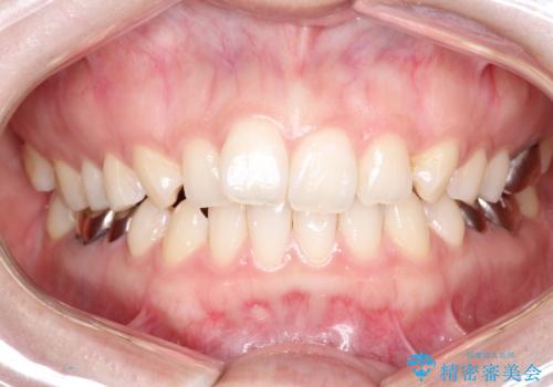 【メタルフリー】銀歯を白くしたい。オールセラミッククラウン。の症例 治療前