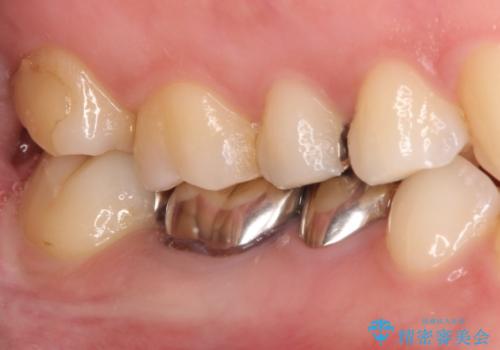 【メタルフリー】銀歯を白くしたい。オールセラミッククラウン。の治療前