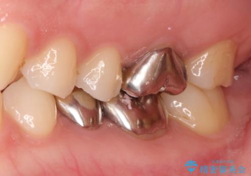 【メタルフリー】銀歯を白くしたい。オールセラミッククラウン。の治療前
