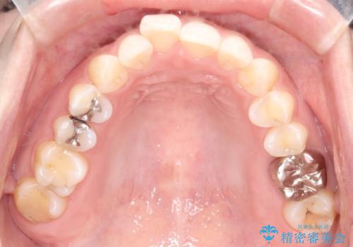 【メタルフリー】銀歯を白くしたい。オールセラミッククラウン。の治療前