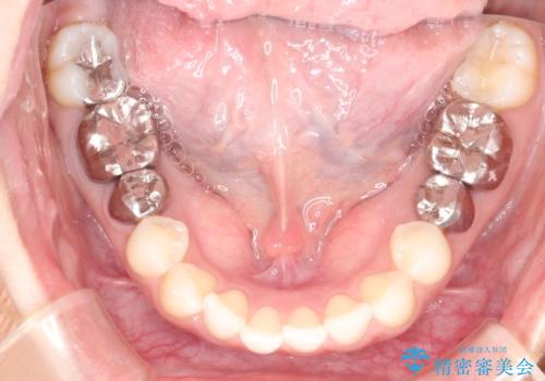 【メタルフリー】銀歯を白くしたい。オールセラミッククラウン。の治療前