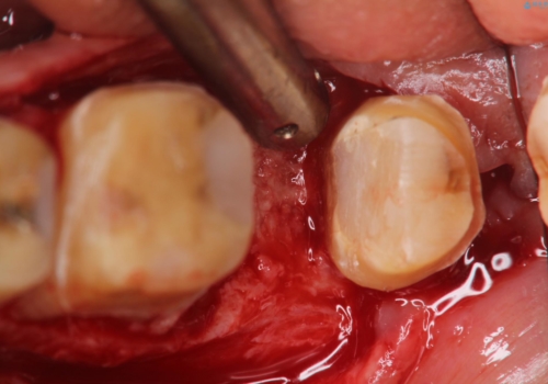 【ヘミセクション】なんとか残したい、割れた奥歯。の治療中