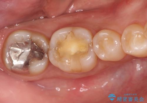 奥歯が痛い。精密根管治療〜オールセラミッククラウンの治療前