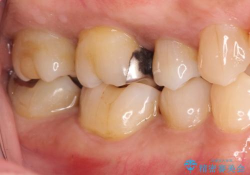 奥歯が痛い。精密根管治療〜オールセラミッククラウンの治療前