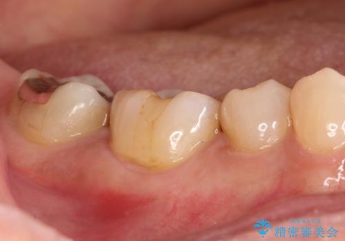 奥歯が痛い。精密根管治療〜オールセラミッククラウンの治療前