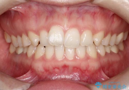 【メタルフリー】銀歯を白くしたい。オールセラミッククラウン。の症例 治療後