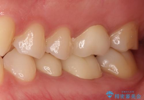 【メタルフリー】銀歯を白くしたい。オールセラミッククラウン。の治療後