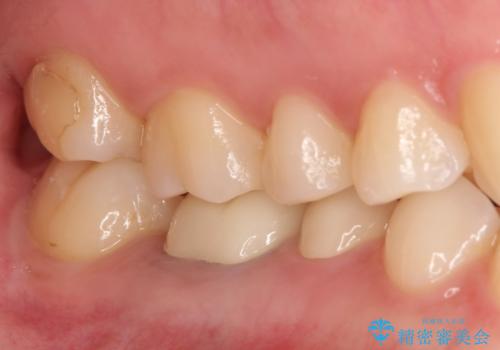 【メタルフリー】銀歯を白くしたい。オールセラミッククラウン。の治療後