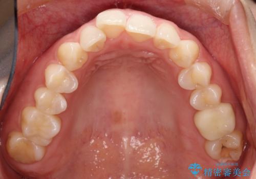 【メタルフリー】銀歯を白くしたい。オールセラミッククラウン。の治療後