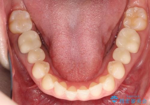 【メタルフリー】銀歯を白くしたい。オールセラミッククラウン。の治療後