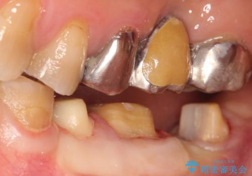 【ヘミセクション】なんとか残したい、割れた奥歯。の治療中