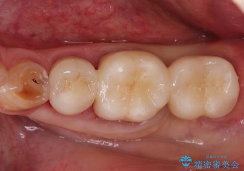 【ヘミセクション】なんとか残したい、割れた奥歯。の症例 治療後