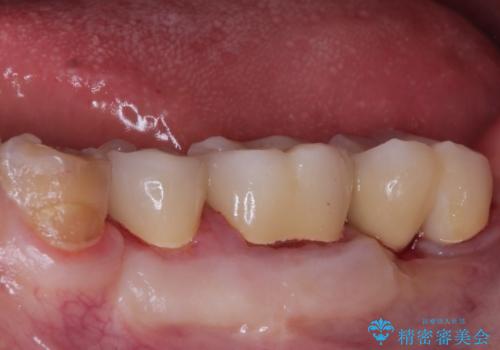【ヘミセクション】なんとか残したい、割れた奥歯。の治療後