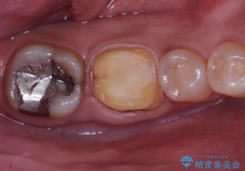 奥歯が痛い。精密根管治療〜オールセラミッククラウンの治療中