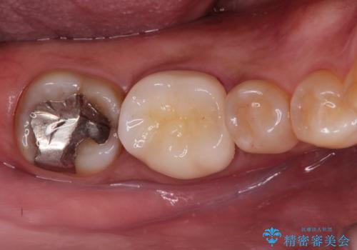 奥歯が痛い。精密根管治療〜オールセラミッククラウンの治療後