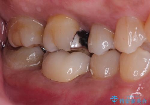 奥歯が痛い。精密根管治療〜オールセラミッククラウンの治療後