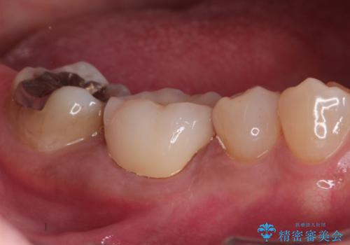 奥歯が痛い。精密根管治療〜オールセラミッククラウンの治療後