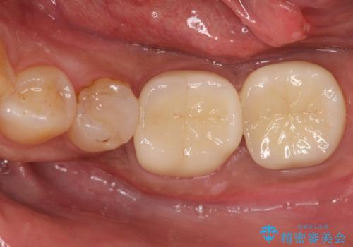 他院で治療しても治らない。奥歯の治療。の症例 治療後