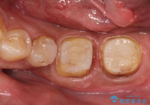 他院で治療しても治らない。奥歯の治療。の治療中