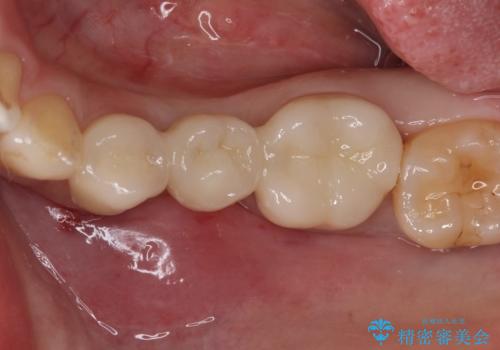 奥歯が痛い。乳歯を抜歯し、ブリッジによる咬合回復。の治療後