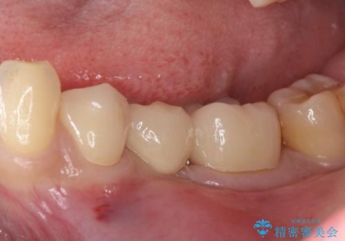 奥歯が痛い。乳歯を抜歯し、ブリッジによる咬合回復。の治療後