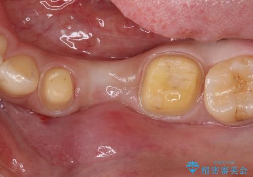 奥歯が痛い。乳歯を抜歯し、ブリッジによる咬合回復。の治療中
