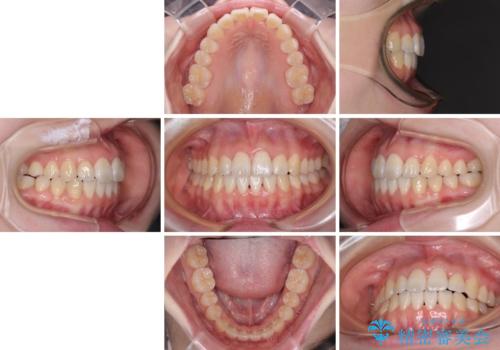 気になる前歯をインビザラインで綺麗にの治療後