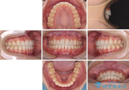 気になる前歯を整えたい インビザライン・ライトでの矯正治療の治療後