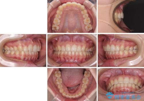 奥歯の倒れた歯を改善 インビザラインでの矯正治療の治療後