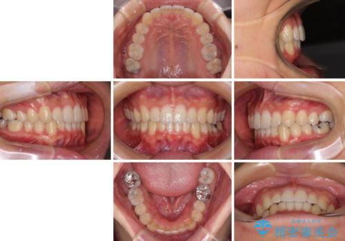 口が少し閉じにくい インビザラインによる非抜歯矯正の治療後