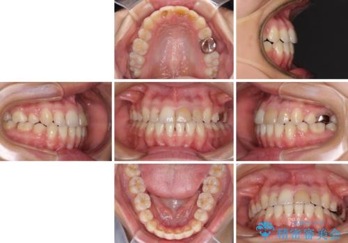 八重歯の抜歯矯正　費用を抑えた矯正装置の治療後