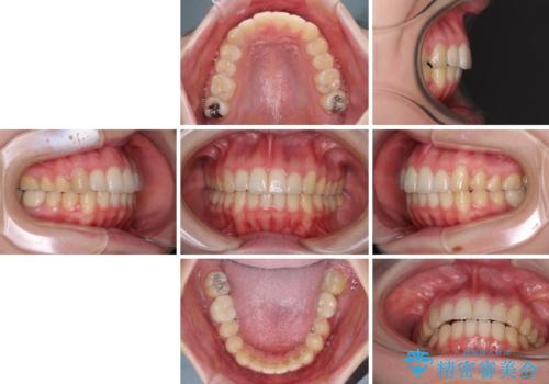 インプラント治療とインビザライン矯正治療 総合歯科治療の治療後