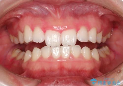 毎月のメンテナンスの治療後