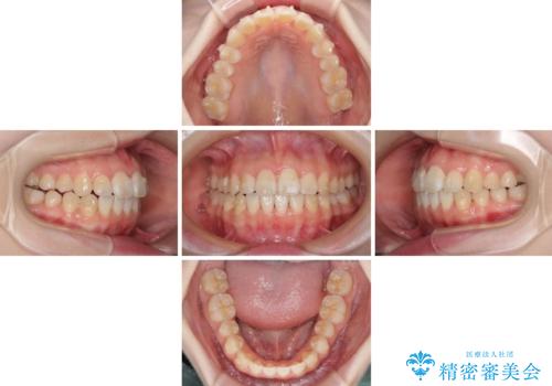 気になる前歯をインビザラインで綺麗にの治療中