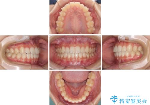 気になる前歯を整えたい インビザライン・ライトでの矯正治療の治療中