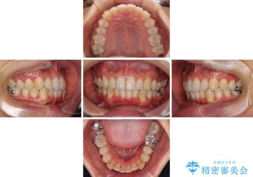 口が少し閉じにくい インビザラインによる非抜歯矯正の治療中