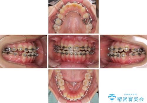 八重歯の抜歯矯正 費用を抑えた矯正装置の治療中