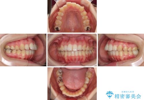 インプラント治療とインビザライン矯正治療 総合歯科治療の治療中