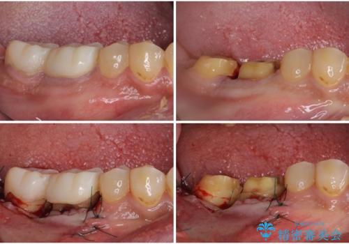 骨の中にまで及んだ深い虫歯 歯周外科処置を用いた補綴治療の治療中
