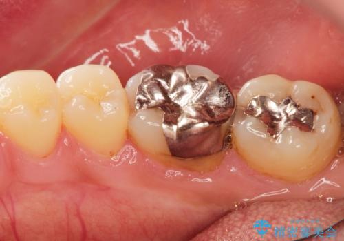 [セラミック治療]  目立つ銀歯を白く①の治療前