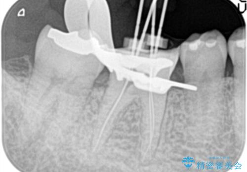 奥歯が痛い。精密根管治療〜オールセラミッククラウンの治療中