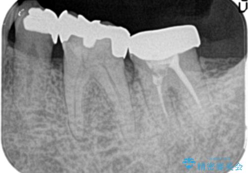 他院で治療しても治らない。奥歯の治療。の治療前