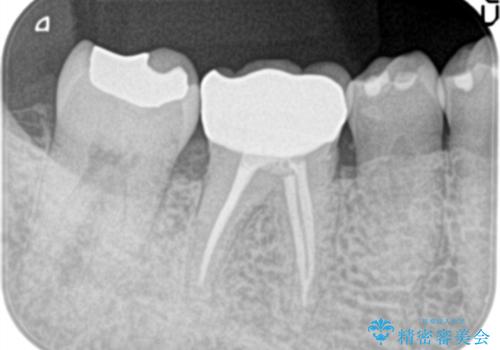 奥歯が痛い。精密根管治療〜オールセラミッククラウンの治療後