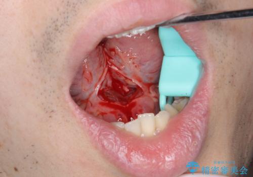 滑舌の改善　舌小帯の形成の治療中